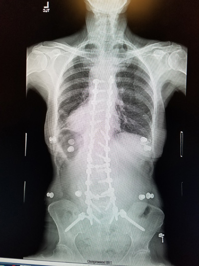 my new spine